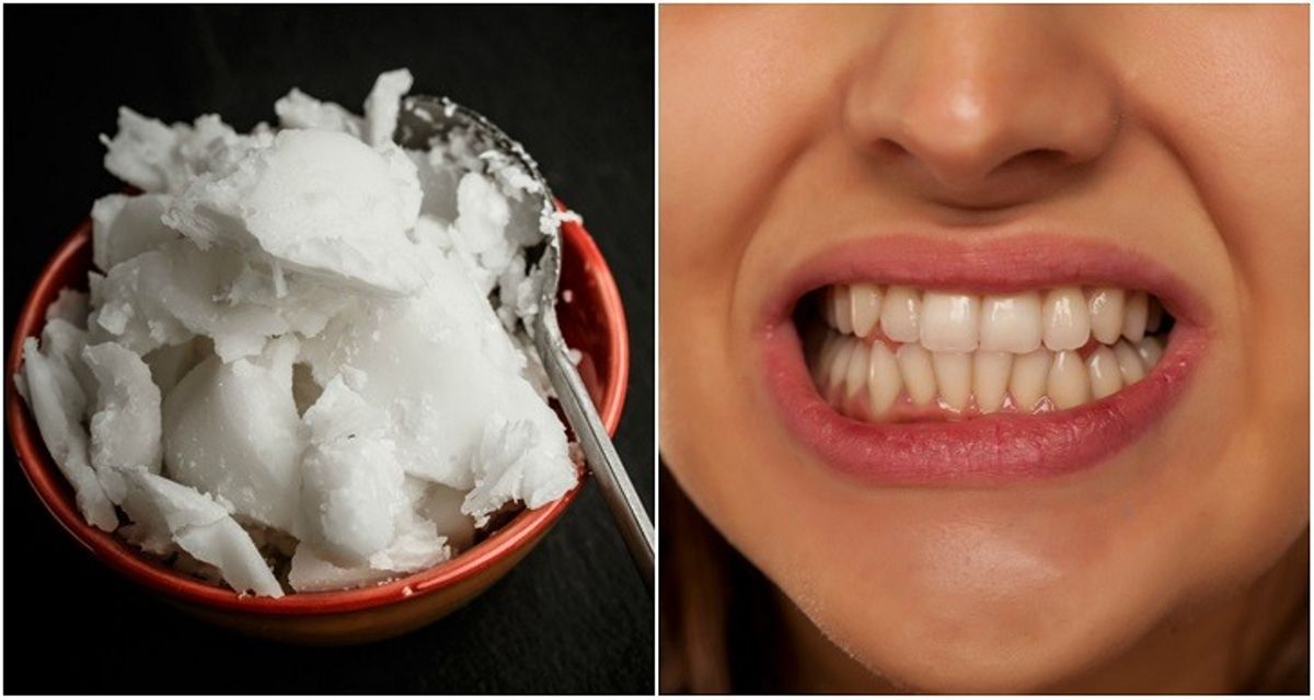 Does Coconut Oil Whiten Your Teeth