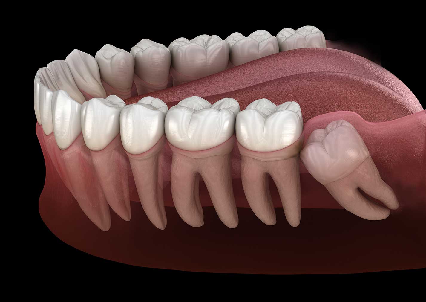 How Long Does Wisdom Tooth Growing Pain Last?